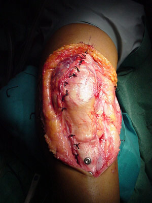 Apto munición Privilegiado Trauma-Scope » Avances en patología de rodilla