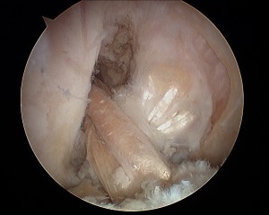 Ligamentoplastia anatómica del LCA
